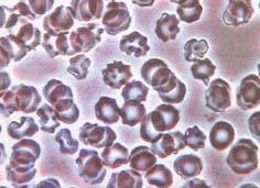 活性酸素に傷つけられた赤血球　形がギザギザ